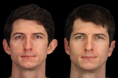 Ears Before & After Gallery - Patient 147938 - Image 1