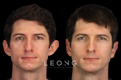 Ears Before & After Gallery - Patient 147938 - Image 1