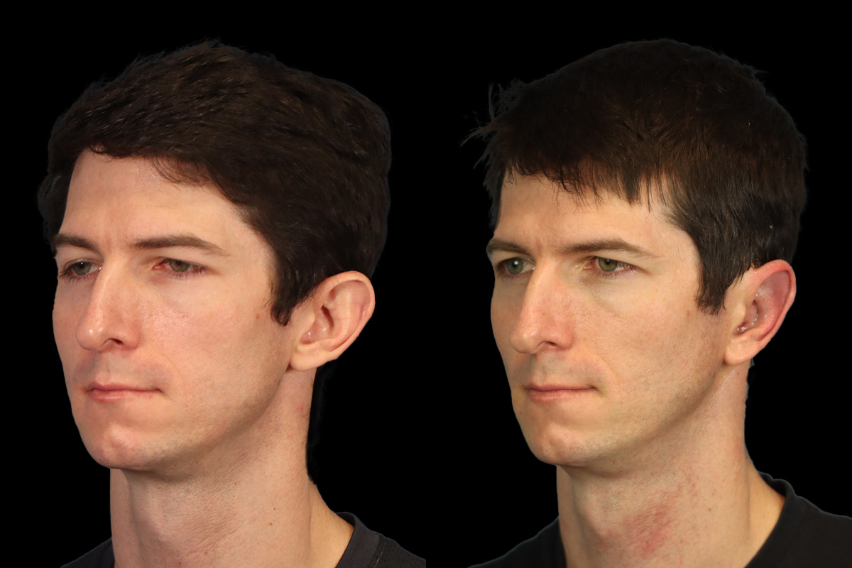 Otoplasty Before & After Gallery - Patient 107066 - Image 5