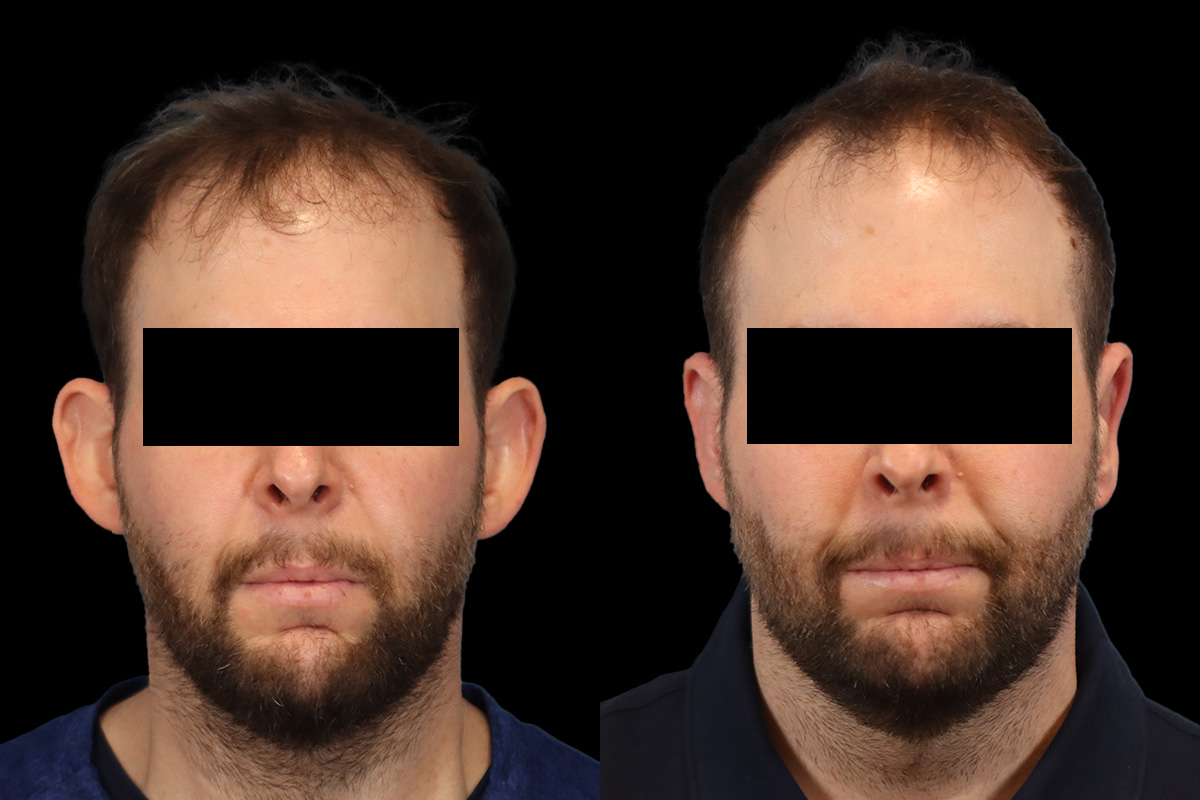 Ears Before & After Gallery - Patient 595729 - Image 1