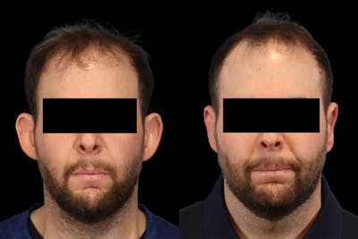 Ears Before & After Gallery - Patient 595729 - Image 1