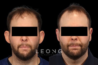 Ears Before & After Gallery - Patient 595729 - Image 1