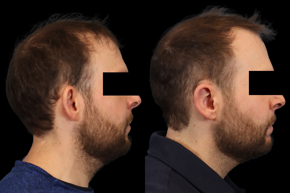 Ears Before & After Gallery - Patient 595729 - Image 3