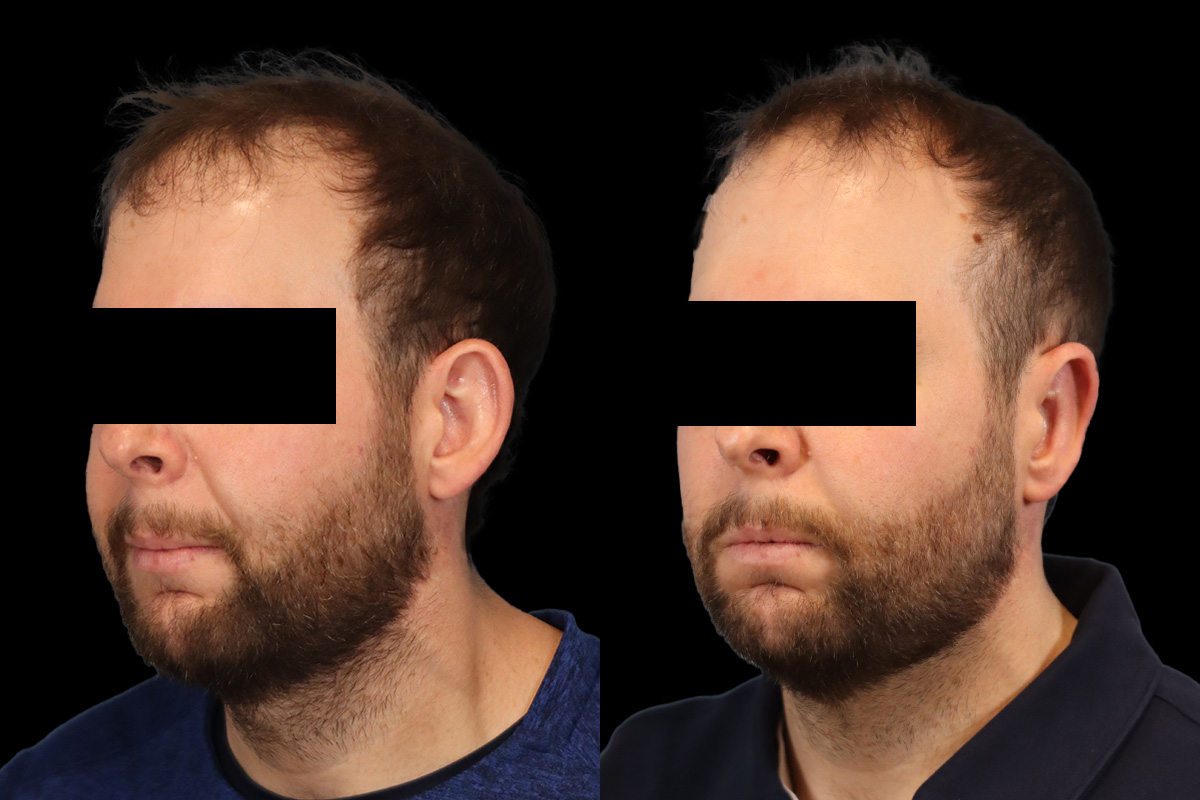 Ears Before & After Gallery - Patient 595729 - Image 4