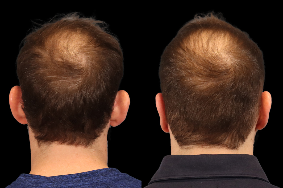 Ears Before & After Gallery - Patient 595729 - Image 6