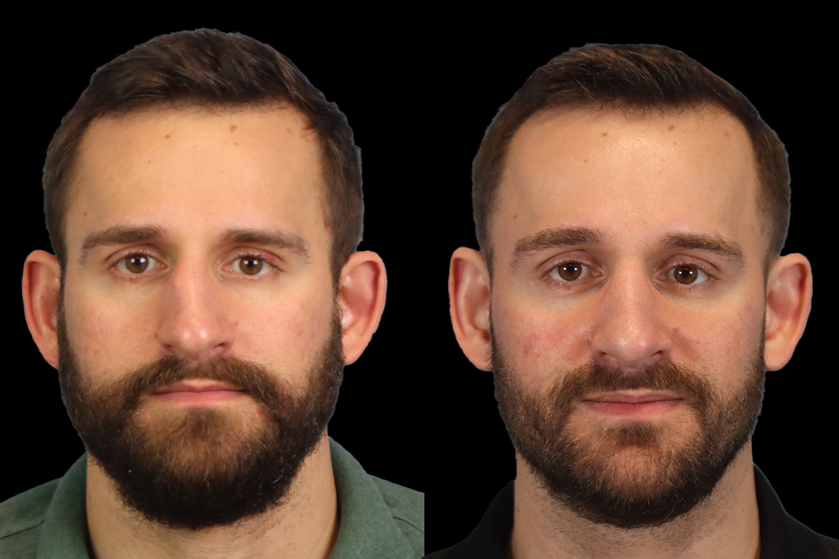 Nose Before & After Gallery - Patient 333928 - Image 1