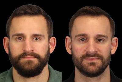 Nose Before & After Gallery - Patient 333928 - Image 1