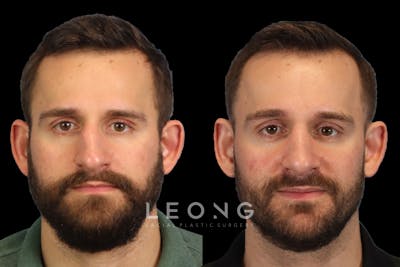 Nose Before & After Gallery - Patient 333928 - Image 1