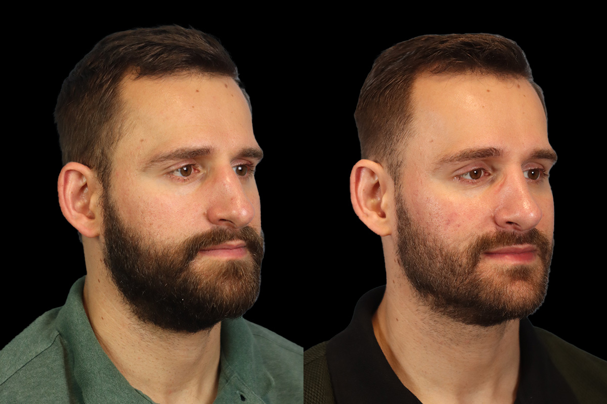 Nose Before & After Gallery - Patient 333928 - Image 3