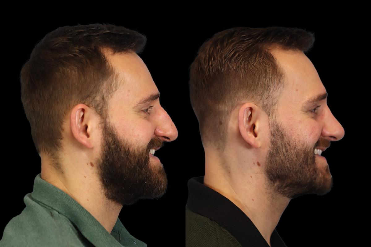 Nose Before & After Gallery - Patient 333928 - Image 6