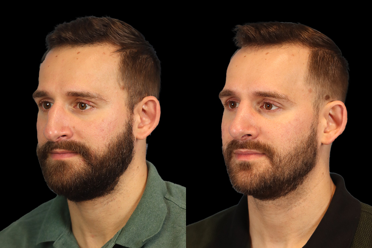 Nose Before & After Gallery - Patient 333928 - Image 7