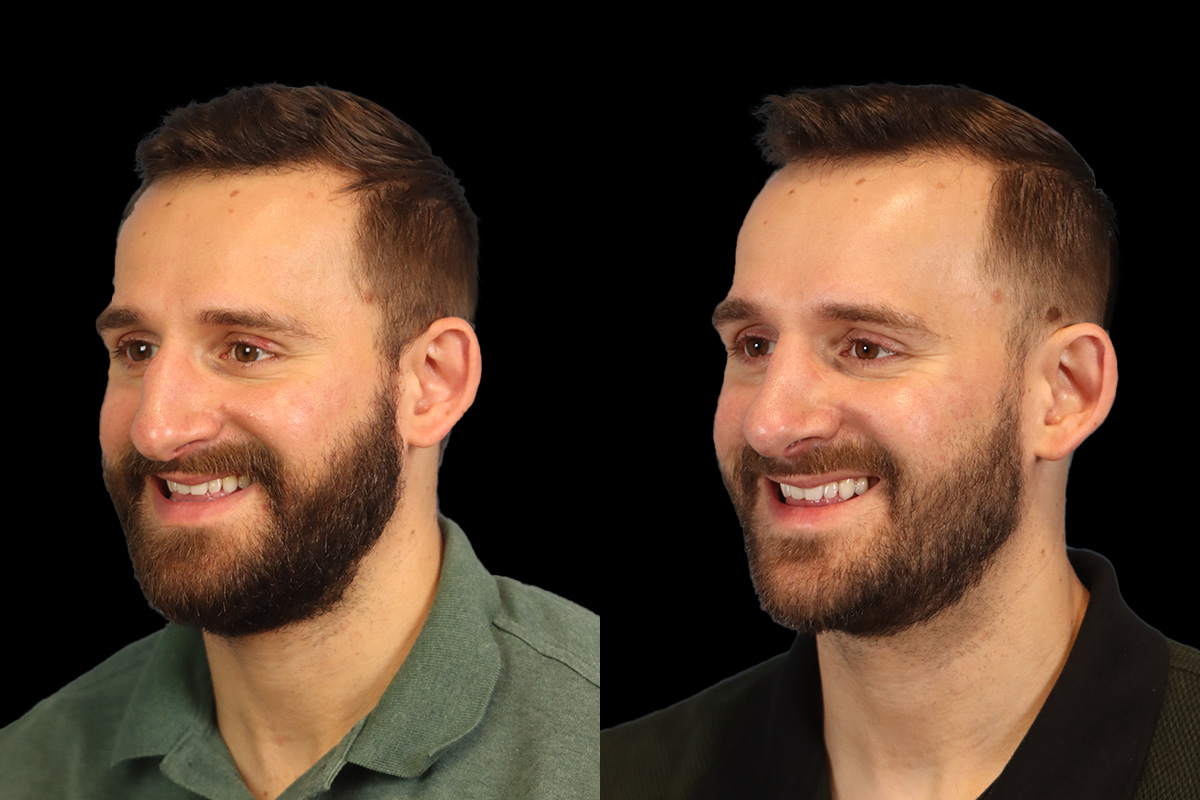 Nose Before & After Gallery - Patient 333928 - Image 8