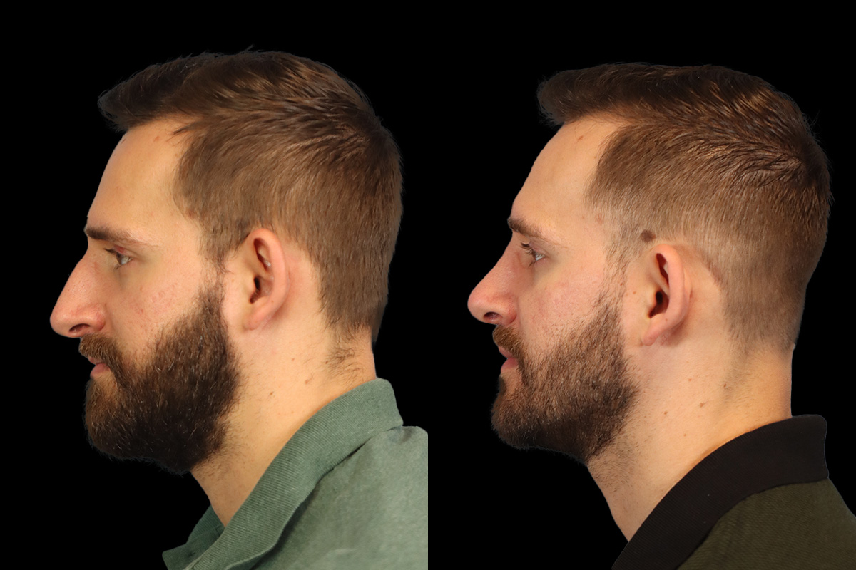 Nose Before & After Gallery - Patient 333928 - Image 9