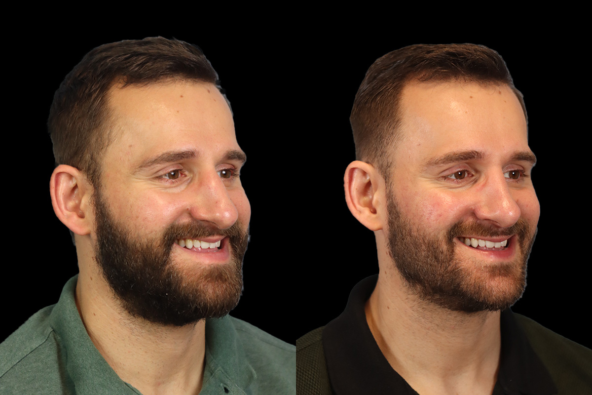 Nose Before & After Gallery - Patient 333928 - Image 4