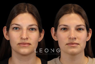Rhinoplasty Before & After Gallery - Patient 977224 - Image 1