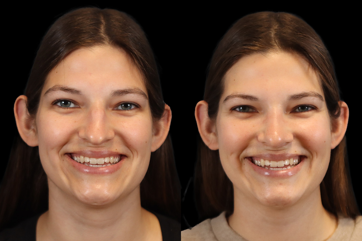 Rhinoplasty Before & After Gallery - Patient 977224 - Image 2