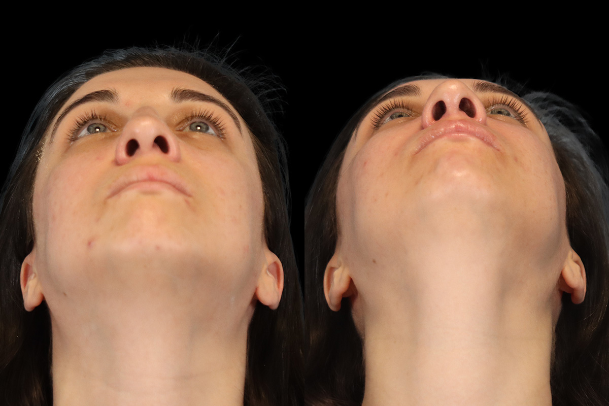 Rhinoplasty Before & After Gallery - Patient 261232 - Image 7
