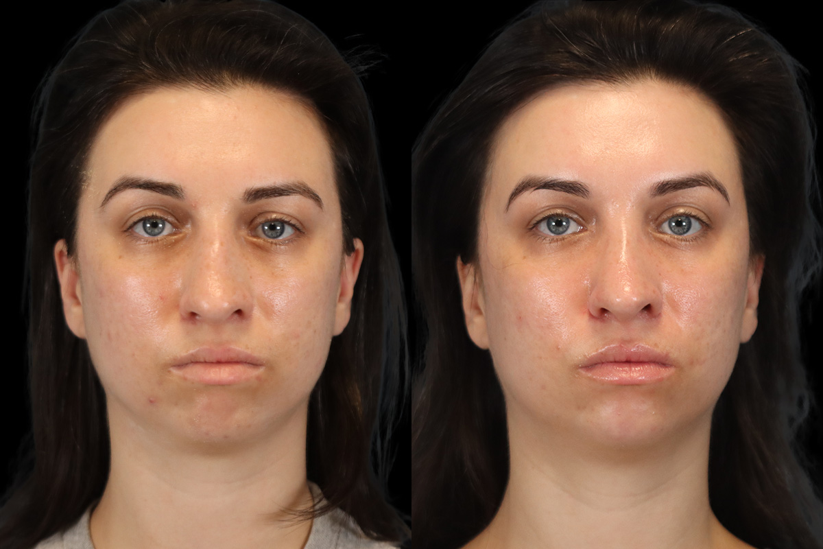 Rhinoplasty Before & After Gallery - Patient 261232 - Image 1