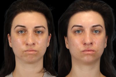 Rhinoplasty Before & After Gallery - Patient 261232 - Image 1