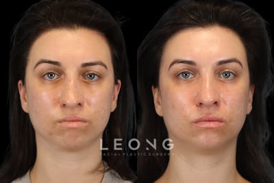 Rhinoplasty Before & After Gallery - Patient 261232 - Image 1