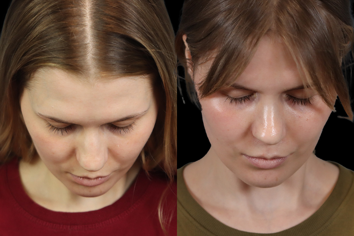 Rhinoplasty Before & After Gallery - Patient 146395 - Image 9