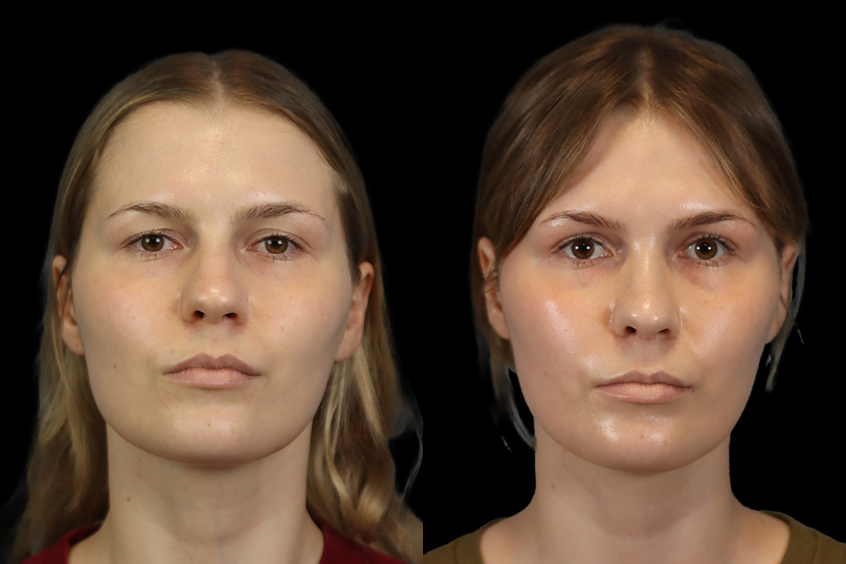 Rhinoplasty Before & After Gallery - Patient 146395 - Image 1