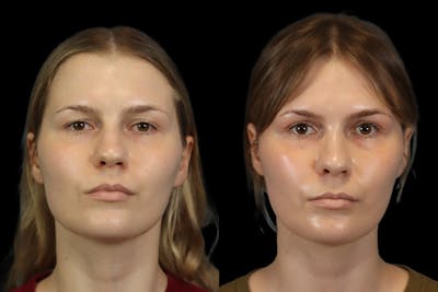Nose Before & After Gallery - Patient 254538 - Image 1