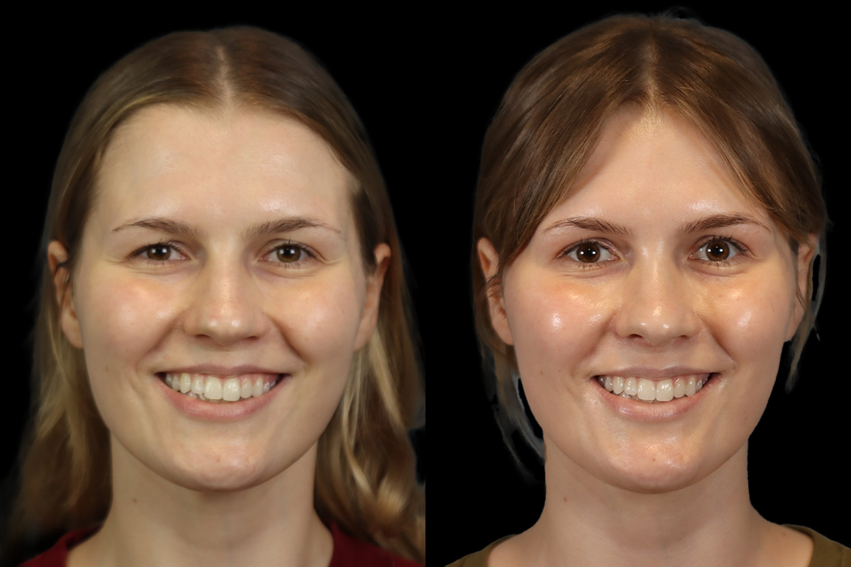 Rhinoplasty Before & After Gallery - Patient 146395 - Image 2