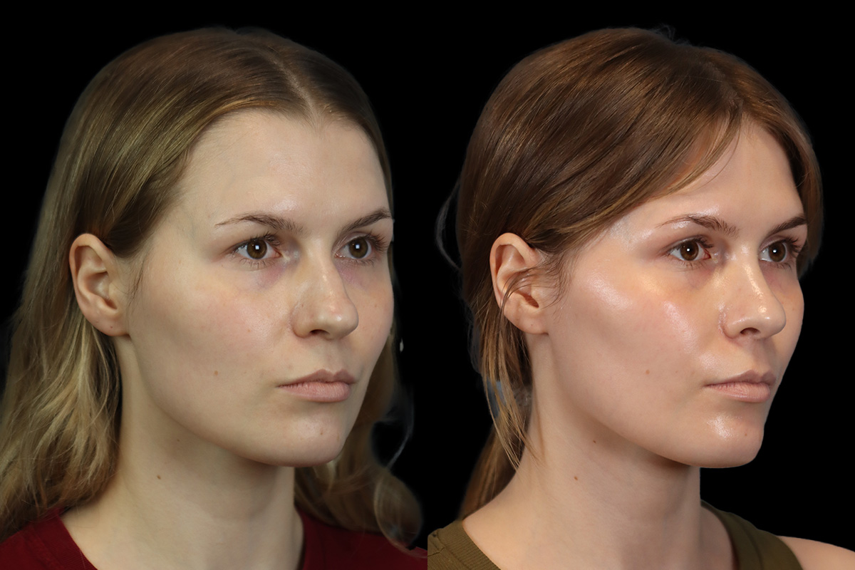 Rhinoplasty Before & After Gallery - Patient 146395 - Image 3