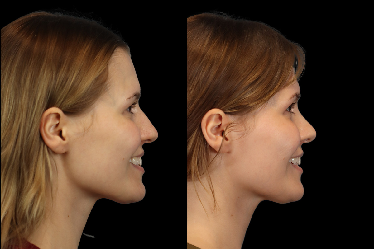 Rhinoplasty Before & After Gallery - Patient 146395 - Image 5