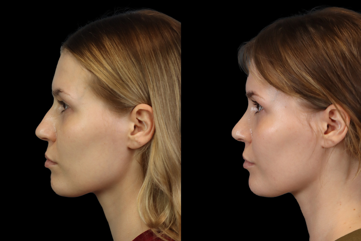 Rhinoplasty Before & After Gallery - Patient 146395 - Image 7