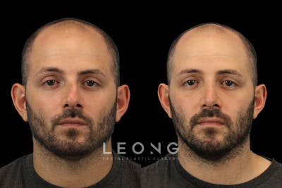 Nose Before & After Gallery - Patient 114047 - Image 1