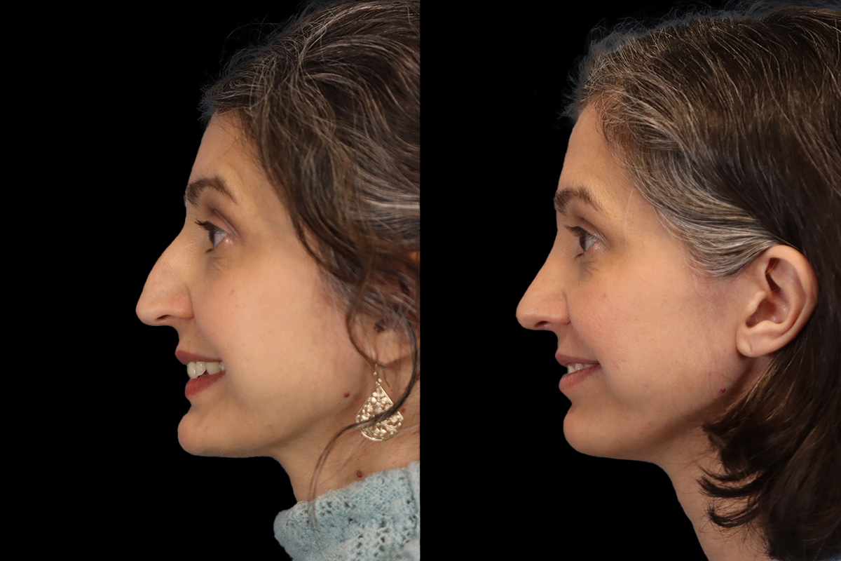 Rhinoplasty Before & After Gallery - Patient 313496 - Image 8