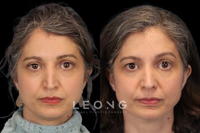 Nose Before & After Gallery - Patient 118375 - Image 1