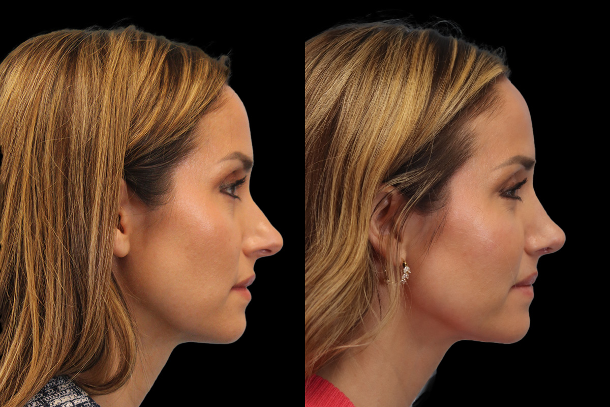Rhinoplasty Before & After Gallery - Patient 117557 - Image 3