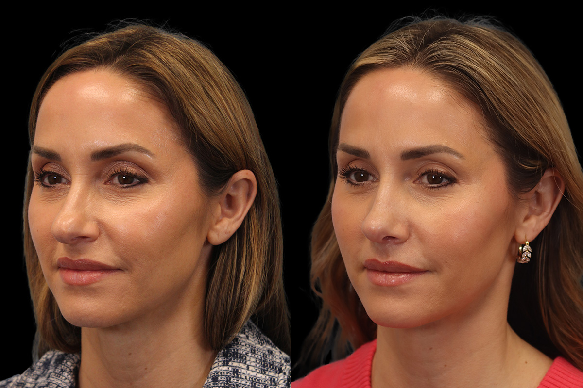 Rhinoplasty Before & After Gallery - Patient 117557 - Image 5