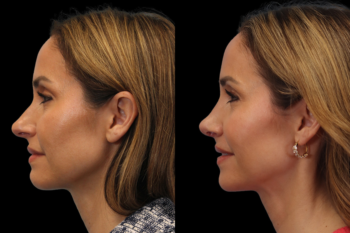 Rhinoplasty Before & After Gallery - Patient 117557 - Image 6