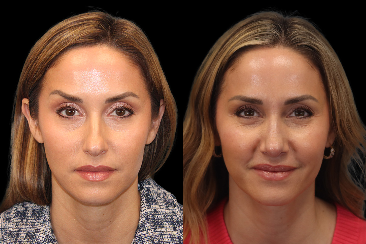 Rhinoplasty Before & After Gallery - Patient 117557 - Image 1
