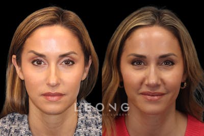 Nose Before & After Gallery - Patient 558650 - Image 1