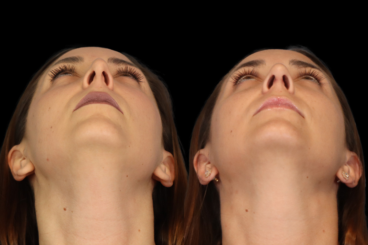 Nose Before & After Gallery - Patient 419306 - Image 10