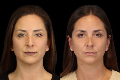 Nose Before & After Gallery - Patient 419306 - Image 1