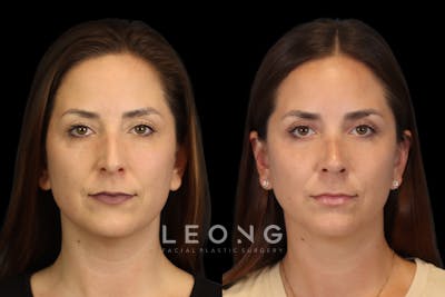 Nose Before & After Gallery - Patient 419306 - Image 1