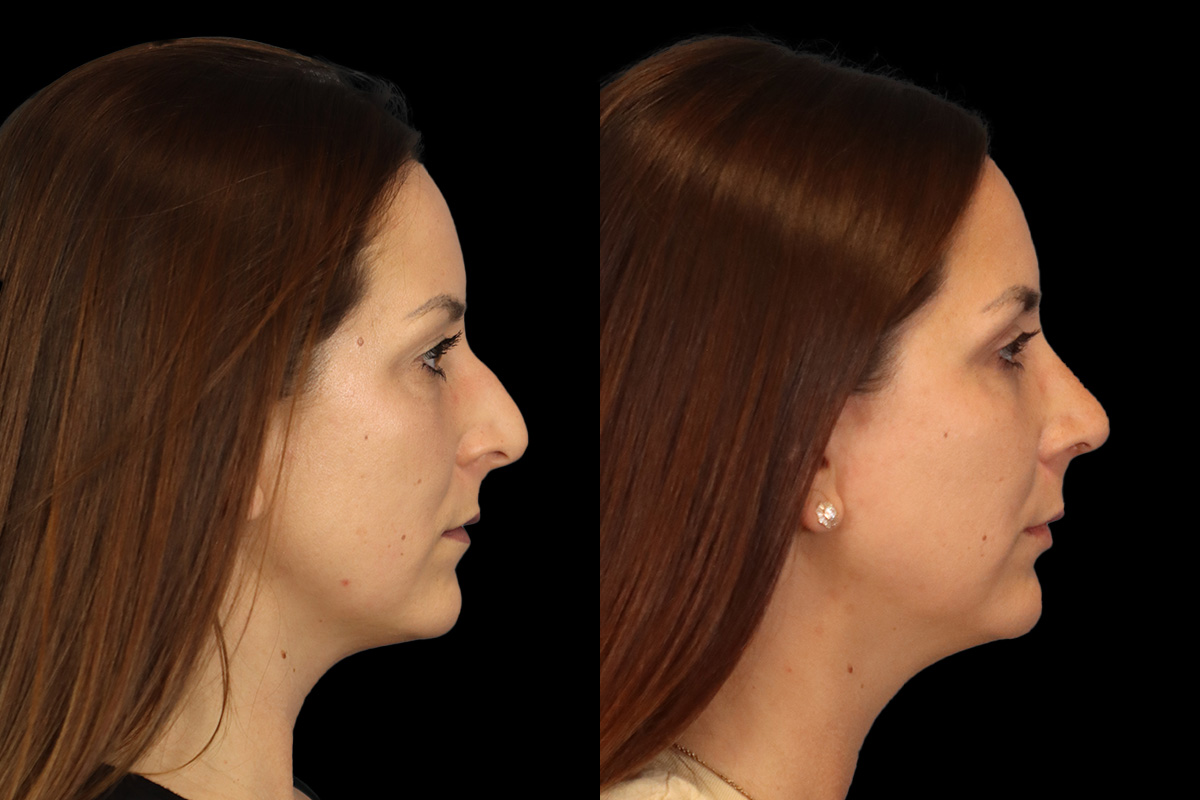 Nose Before & After Gallery - Patient 419306 - Image 4