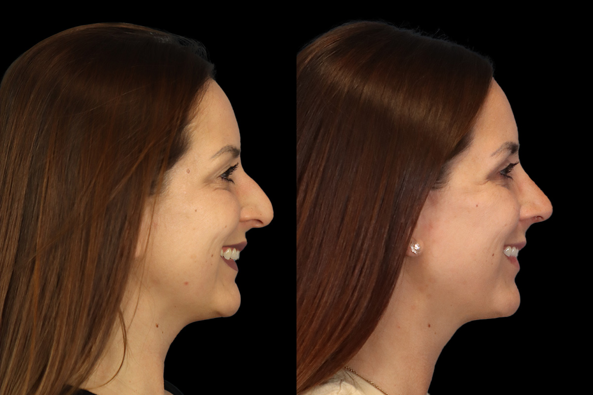 Nose Before & After Gallery - Patient 419306 - Image 5