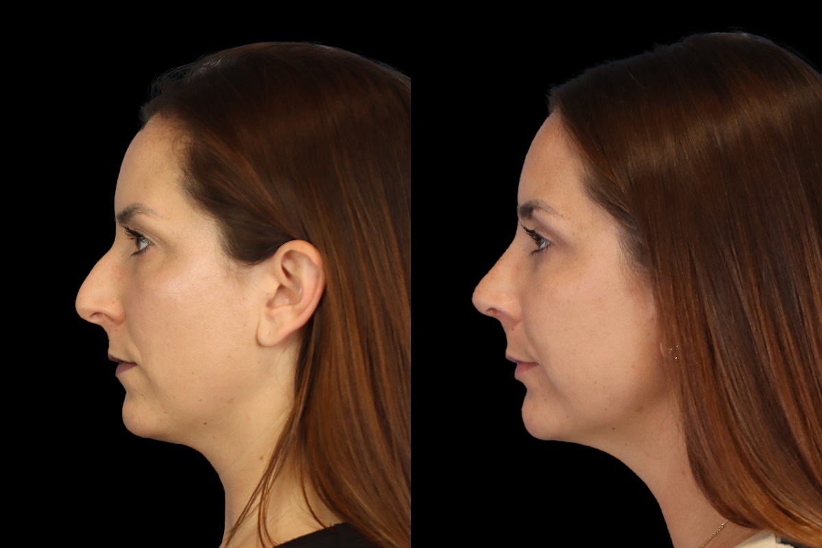 Nose Before & After Gallery - Patient 419306 - Image 7