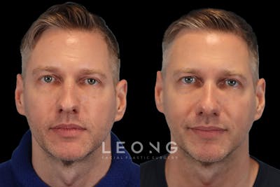 Nose Before & After Gallery - Patient 770764 - Image 1