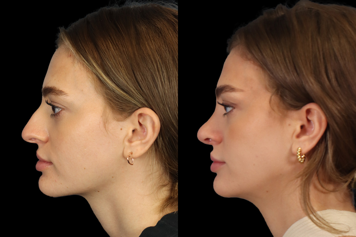 Nose Before & After Gallery - Patient 499680 - Image 7