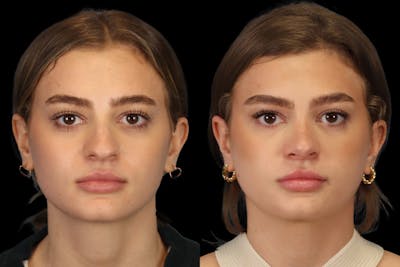 Nose Before & After Gallery - Patient 499680 - Image 1