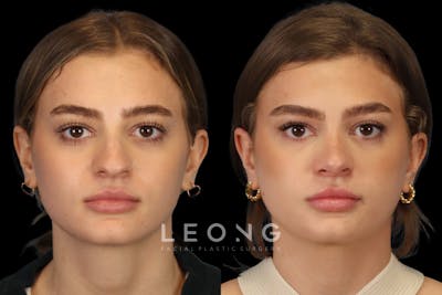 Nose Before & After Gallery - Patient 499680 - Image 1