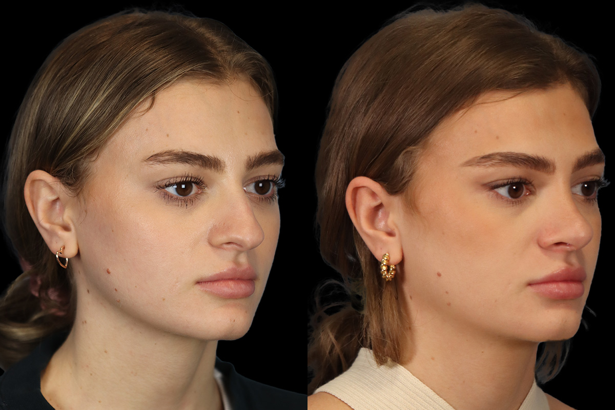 Nose Before & After Gallery - Patient 499680 - Image 3